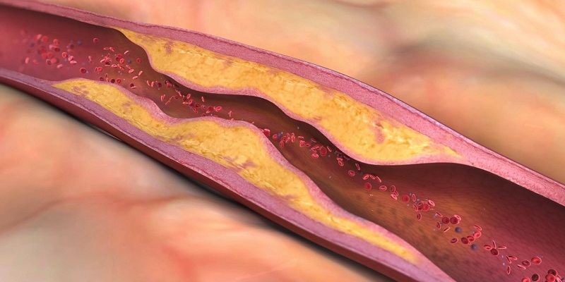 Thường xuyên dùng giảo cổ lam với lượng vừa phải sẽ làm giảm cholesterol máu, hạn chế tạo mảng xơ vữa.