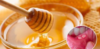 8 cách trị nhiệt miệng hiệu quả, nhanh khỏi