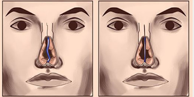 Hậu quả khi về già với những người nâng mũi: Giờ nhìn đẹp thôi, vài năm nữa mới 'thấm thía'4