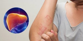 5 dấu hiệu cảnh báo bệnh gan đã đi vào giai đoạn nặng: Chỉ cần 1/5 cũng cần đi khám gấp