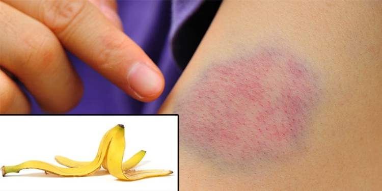 Vỏ chuối có công dụng giúp vết bầm tím hồi phục mạnh mẽ.