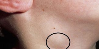 Trên cổ xuất hiện 2 dấu hiệu bất thường này, có thể tế K trong cơ thể đã thức tỉnh: Ai cũng cần biết