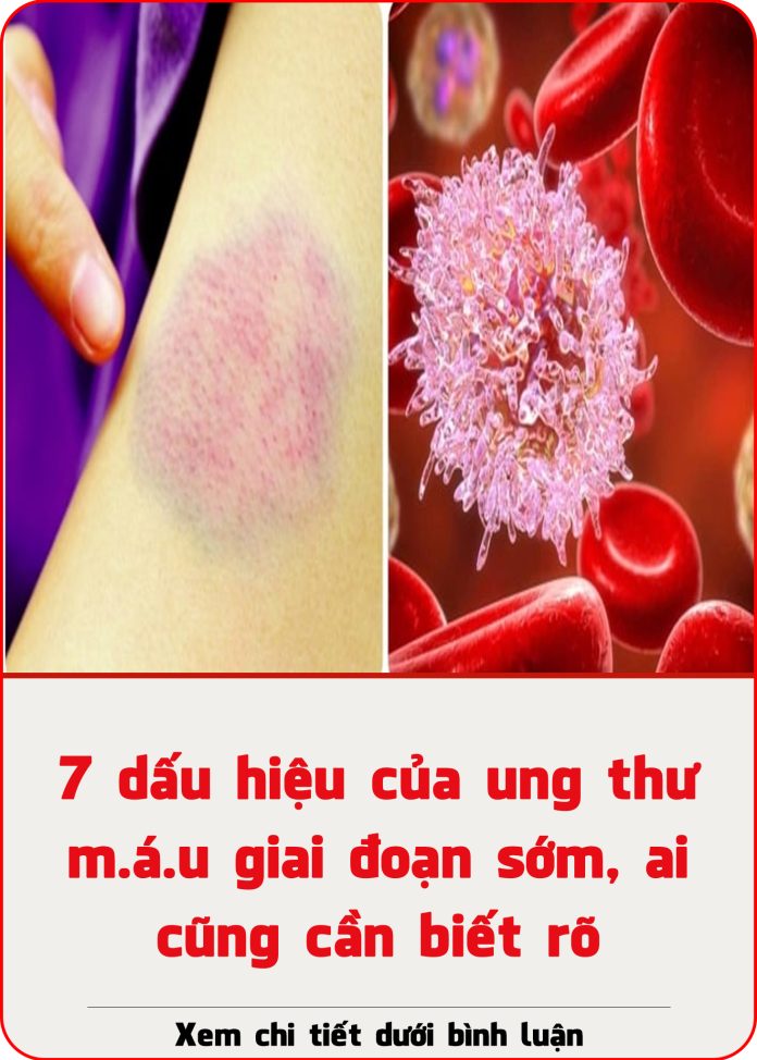 7 dấu hiệu của ung thư máu giai đoạn sớm, ai cũng cần biết rõ