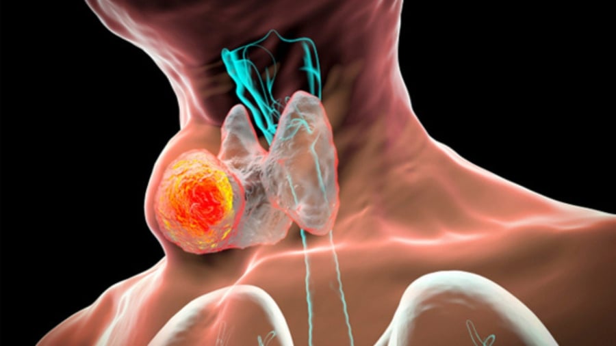 8 dấu hiệu ung thư tuyến giáp giai đoạn đầu, số 1 nhìn là thấy ngay