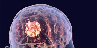 Bệnh u não ng:uy h:iểm thế nào? Ai có dấu hiệu này cần đi kiểm tra ngay trước khi quá muộn