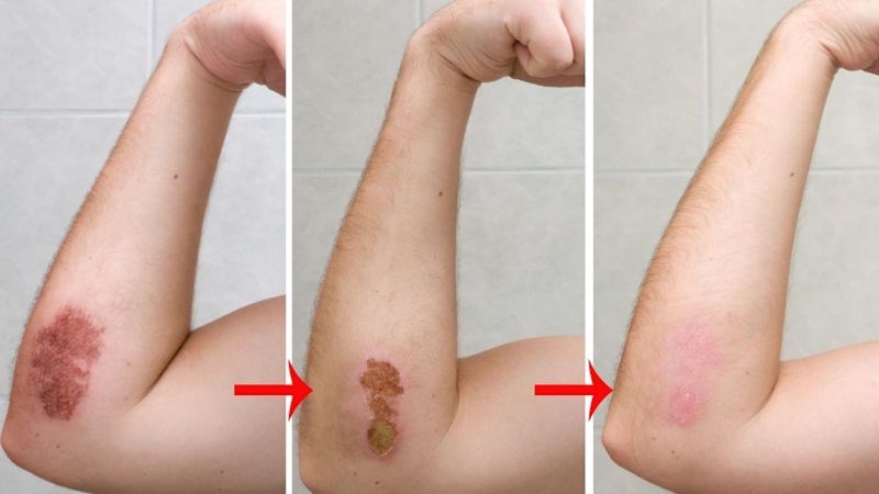 Tính kháng khuẩn, kháng viêm giúp mau lành vết thương