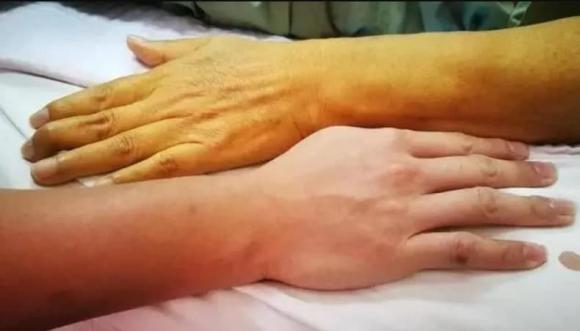 gan nhiễm mỡ, dấu hiệu gan nhiễm mỡ