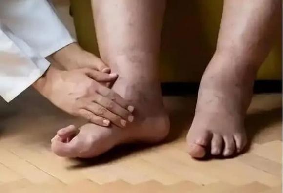 giấc ngủ, đột quỵ, bệnh tim mạch