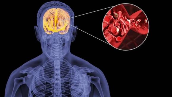 nhồi máu não, sức khỏe, chăm sóc sức khỏe, nguyên nhân gây nhồi máu não, thủ phạm gây nhồi máu não