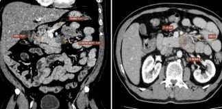 Phát hiện mắc loại UT có tỷ lệ t:ử v:ong cao bậc nhất sau khi có 1 dấu hiệu