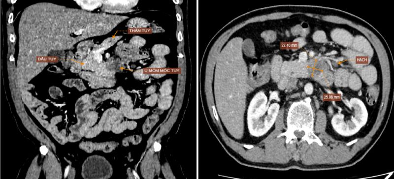 Phát hiện mắc loại ung thư có tỷ lệ tử vong cao bậc nhất sau khi có 1 dấu hiệu - Ảnh 1.