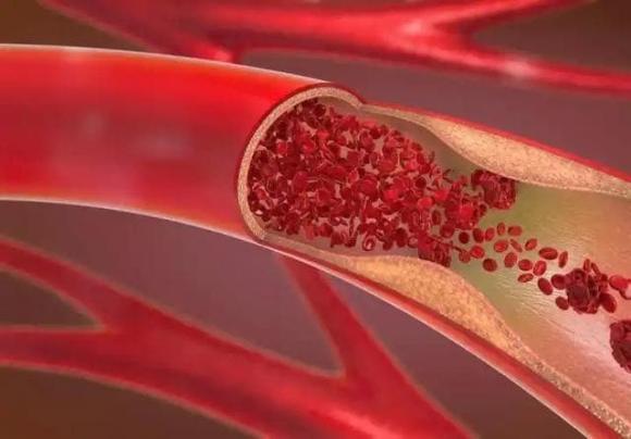 tắc nghèn mạch máu, cục máu đông, đi bộ