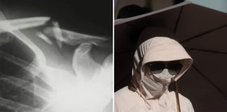 Một phụ nữ bị g:ãy x:ương do thói quen che nắng cẩn thận quá mức