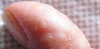 Vào mùa hè, tôi xuất hiện những mụn nước nhỏ. Có chuyện gì thế?