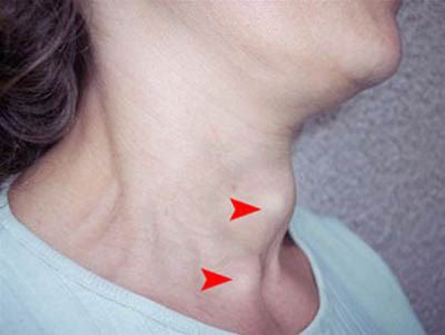 Từ chối phẫu thuật, người phụ nữ về nhà kiên trì uống nước hoa đu đủ đực để tiêu u tuyến giáp, sau 1 năm nhận kết quả bất ngờ - Ảnh 4.