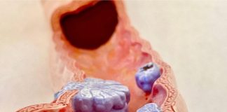 Phát hiện u-ng thư đại tràng giai đoạn 3 từ 1 triệu chứng xuất hiện 10 lần/ ngày