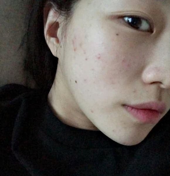  Khi mụn xuất hiện dày đặc ở vùng cằm, quai hàm, quanh miệng rồi lan sang má hoặc trán, và không thuyên giảm dù đã chăm sóc da đúng cách, đó có thể là dấu hiệu rối loạn nội tiết tố. 