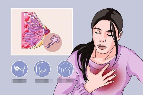 Lý do ung thư vú có mặt trong danh sách này chính là nhờ thể bệnh đặc biệt – ung thư biểu mô ống dẫn sữa tại chỗ (DCIS).