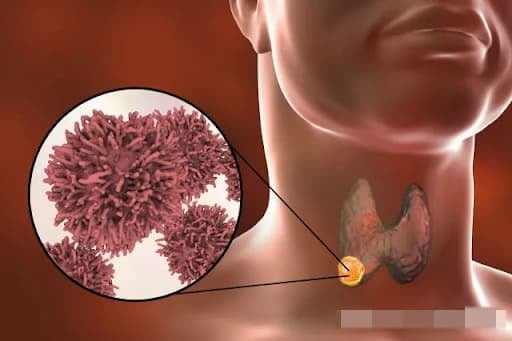 Đây là loại ung thư tuyến giáp phổ biến nhất, chiếm khoảng 80–90% các ca bệnh. 