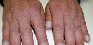 Khi gan suy nặng, cơ thể sẽ sưng ở 5 chỗ: Có 1 cũng nên đi khám ngay