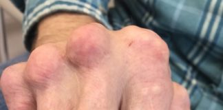 Danh sách đen 6 thực phẩm là “đồng phạm” của bệnh gout nhưng nhiều người ăn vô tội vạ