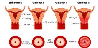 Người vợ 38 tuổi bị UT cổ tử cung vì chiều theo “sở thích” của chồng: Dù yêu chồng đến mấy vẫn cần tỉnh táo
