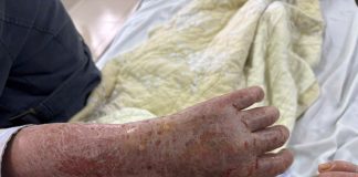 Người phụ nữ bị ngứa dữ dội đến mức “ảo giác có sâu bò”: Nguyên nhân gây sốc từ thói quen nhiều người Việt vẫn làm