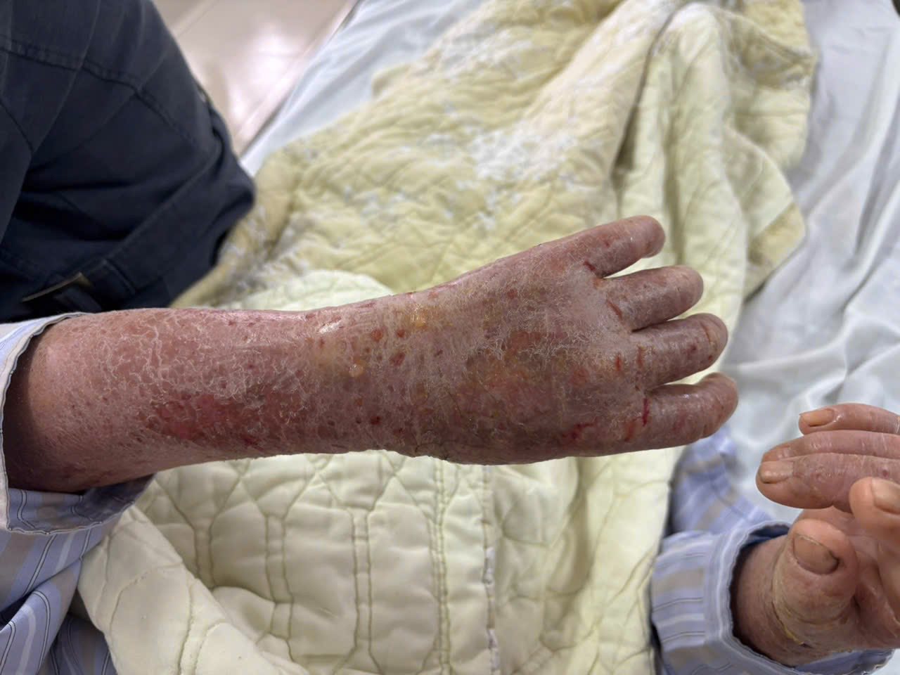 Người phụ nữ bị ngứa dữ dội đến mức “ảo giác có sâu bò”: Nguyên nhân gây sốc từ thói quen nhiều người Việt vẫn làm- Ảnh 1.