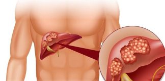 4 dấu hiệu buổi tối báo hiệu Gan đang suy yếu