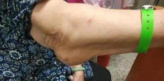 Cảnh báo UT: 4 dấu hiệu ở cánh tay tuyệt đối không được bỏ qua – Phát hiện sớm cứu sống bạn