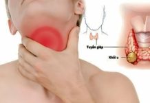 7 dấu hiệu sớm của K tuyến giáp, nhiều người chủ quan bỏ qua