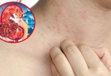 6 dấu hiệu cảnh báo suy thận, nhiều người bỏ qua