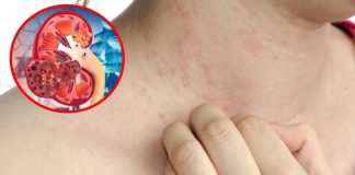 6 dấu hiệu cảnh báo suy thận, nhiều người bỏ qua