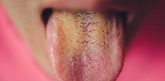 Nếu kiểm tra lưỡi có màu vàng, hãy cẩn trọng với 5 bệnh này