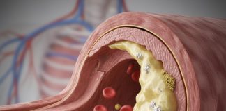 Nguy cơ đột quỵ tăng vọt: 3 hành vi hại mạch máu người trẻ thường mắc