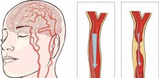 Tại sao 30 năm trước người bị nhồi m:áu não ít mà hiện nay lại càng nhiều? 4 loại thực phẩm được khuyên nên ăn ít hơn
