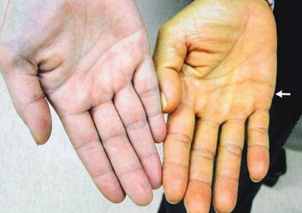 Những dấu hiệu bệnh gan