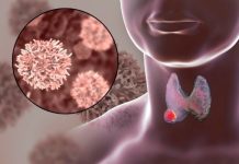 7 dấu hiệu nhận biệt bệnh K vòm họng sớm: Có 1 thôi cũng nên đi khám gấp