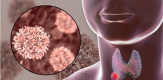 7 dấu hiệu nhận biệt bệnh K vòm họng sớm: Có 1 thôi cũng nên đi khám gấp