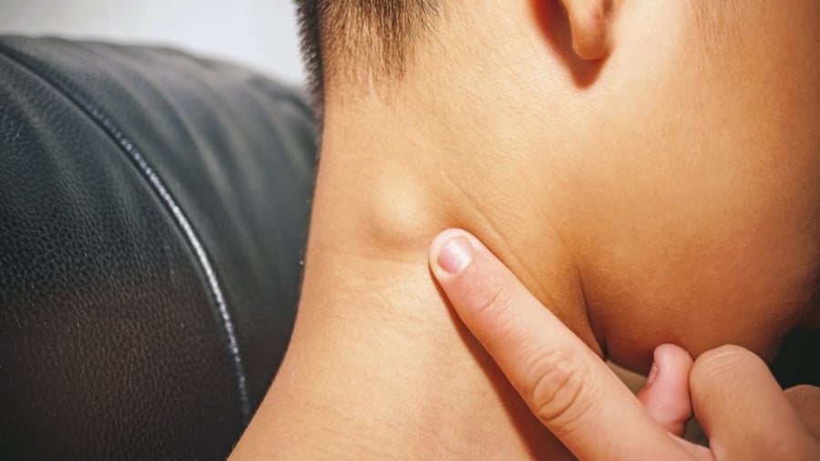 Xuất hiện khối u hoặc cục nổi ở vùng cổ 