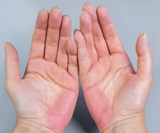 Khi chức năng gan bị suy giảm, những mạch ở bàn tay giãn nở nhiḕu hơn và dẫn ᵭḗn ửng ᵭỏ lòng bàn tay. (Ảnh minh hoạ)